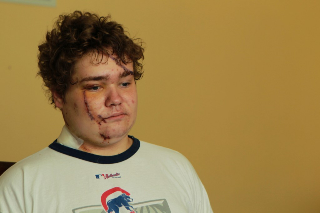 Andrew Wegrzyn of Chicago, Illinois, shows his facial and scalp injuries he sustained in a car accident in 2011
